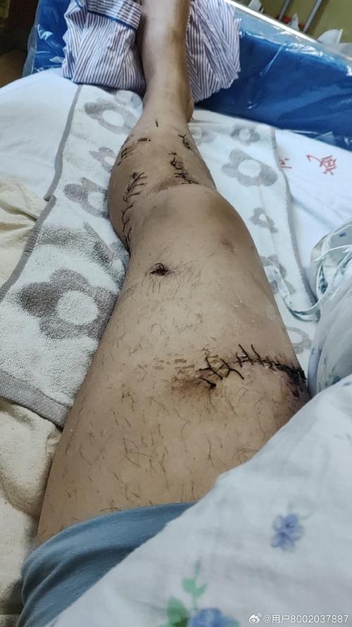 腿腿被刺事件“背后” 第1张 腿腿被刺事件“背后” 第1张