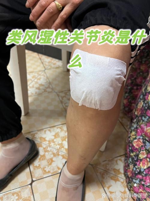 风湿性关节炎三年用药小测评!我的关节炎终于缓解了! 第1张 风湿性关节炎三年用药小测评!我的关节炎终于缓解了! 第1张