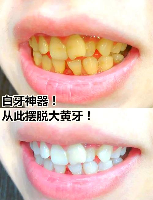 美白牙齿小妙招,让你轻松告别大黄牙 第1张 美白牙齿小妙招,让你轻松告别大黄牙 第1张
