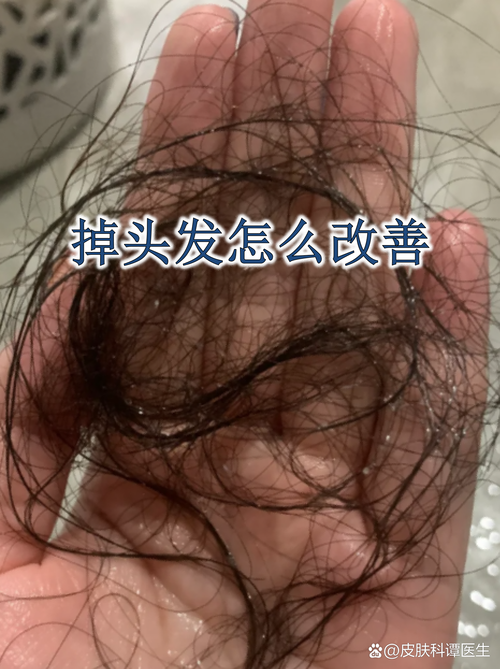 夏季容易掉头发,四招帮你预防脱发 第1张 夏季容易掉头发,四招帮你预防脱发 第1张